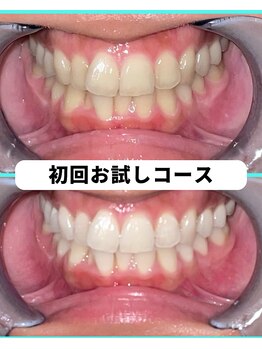 ホワイトニングビューティー 吉祥寺店/ホワイトニング 初来店