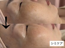 サロン ドロップ 上小田井(Salon drop)/「シミ改善」途中経過
