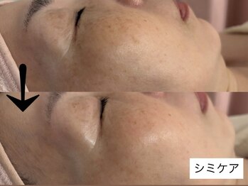 サロン ドロップ 上小田井(Salon drop)/「シミ改善」途中経過