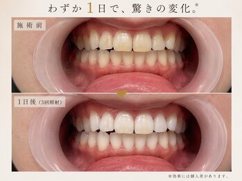ホワイトニング専門店BRILLER 久屋大通店【7月NEW OPEN（予定）】の写真/高効果ホワイトニングによる圧倒的な効果を１回でご提供◎理想の白さ/痛みの少ないホワイトニング♪