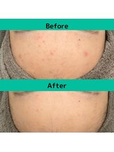 クレドペール(Eclat de Perles)/顔全体のニキビでお悩み。敏感肌