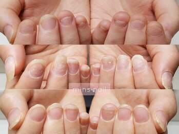 深爪矯正before&after