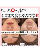 アルムダアクア 天王寺店(Aleumda AQUA)/ハーブピーリング/大阪/天王寺