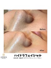 アクシア ビューティー サロン(AXSIA)/【ハイドラ】BeforeAfter