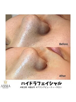 アクシア ビューティー サロン(AXSIA)/【ハイドラ】BeforeAfter
