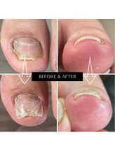 まき爪晴れる/伸びない爪もちゃんと伸びます