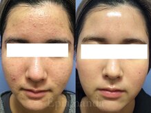 エピア 半田店(Epia)/18～20歳/繰り返すニキビケア