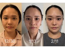 アグテ(Agte)/OPEN限定モニター☆インセル