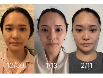 アグテ(Agte)/OPEN限定モニター☆インセル