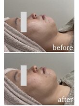 メディカルエース(MedicalAce)/ブライティングリフト×脂肪燃焼