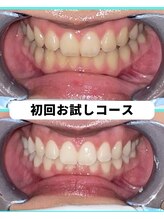 ホワイトニングビューティー 吉祥寺店/ホワイトニング　初来店