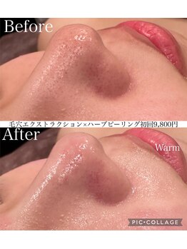 ウォーム(Warm)/圧倒的に変化の出る毛穴ケア