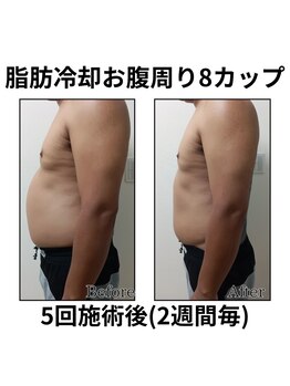 ホワイトビューティーラボ(White Beauty Lab)/【痩身】お腹周り×５回施術