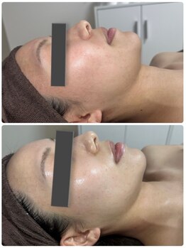 セルヴィノバ(CELL VI NOVA)の写真/ニキビケアや肌トラブル改善には次世代ハーブピーリング♪毛穴レスな透明感溢れる陶器肌へ導きます！