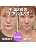 【こじらせ脂肪撃退】二重顎撃退×小顔が叶う★プラチナム美容液導入2,980円