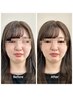 【一回でも実感！】美容鍼＋小顔矯正でむくみ・たるみ・フェイスライン改善☆