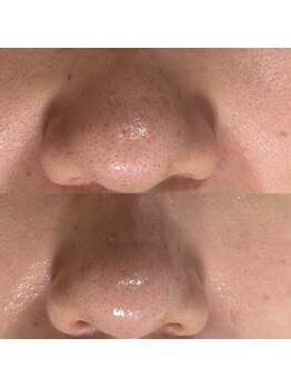 スキニティ(Skinity)/陶肌ピール×毛穴洗浄