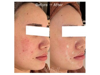 ミベル(MeBell)/【肌質改善】