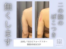 ベベティー(BEBETIE)/当日ビフォアフ☆二の腕スッキリ