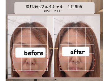 エイル(Eir)の写真/１回の施術で写真のような違いに！３０代からのケアで未来がかわります。