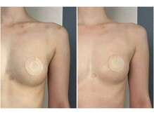 モア(moa)/まんまるバスト/１回での変化