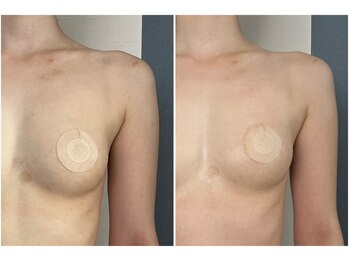 モア(moa)/まんまるバスト/1回での変化