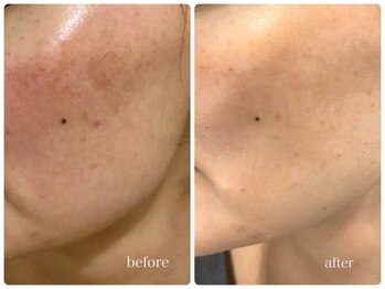 ベルネ(BELLUNE)/ベルネ式シミ改善