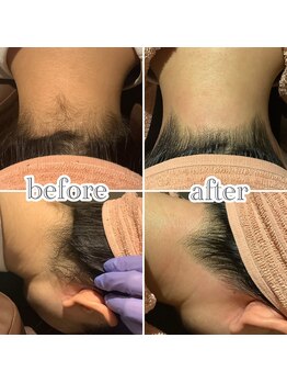 ジグリー(JIGGLY)/ワックス脱毛と光脱毛の併用◎