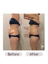 なごみ 菊池店/脂肪撃退【レモンボトル6cc】