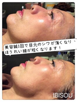 プロぺ鍼灸整骨院/コラーゲン誘発美容鍼とは