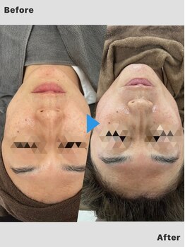 雅凪/微細針ピーリング ビフォアフ