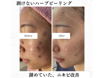 ラヴェンナサロン 札幌店(Ravenna salon)/繰り返すニキビケア諦めないで！