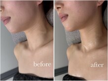 カヌヌ(kanunu)/小顔/痩身（ハイパーナイフ）