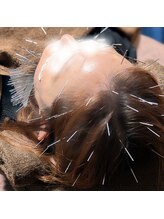 あいこ鍼灸院/100本美容鍼＋頭皮50本