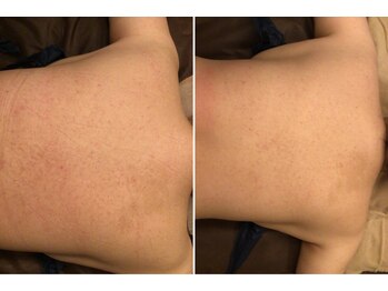 ミモザ/背中ニキビも1度で減少!