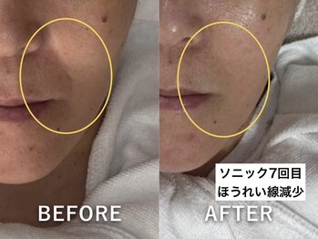 ラカ 明石(Laka)/ほうれい線・フェイスライン