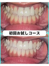 ホワイトニングビューティー 吉祥寺店/ホワイトニング　初来店