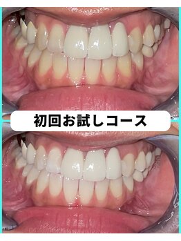 ホワイトニングビューティー 吉祥寺店/ホワイトニング 初来店