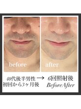 エリクサー 熊谷店(Elixir)/40代後半6回照射