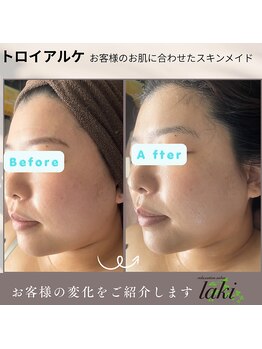 リラクゼーションサロン ラキ(laki)/肌質改善したい人は