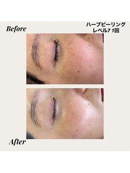 ノースフェイシャルズ(North facials)/ハーブピーリング　レベル7