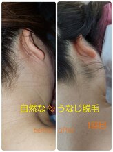 エアレ(eare)/うなじ脱毛