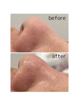 ムー(mu)/毛穴美人コース×光フェイシャル
