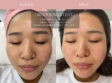 ジョリー(JOLi)/顔脱毛/韓国美肌ワックス