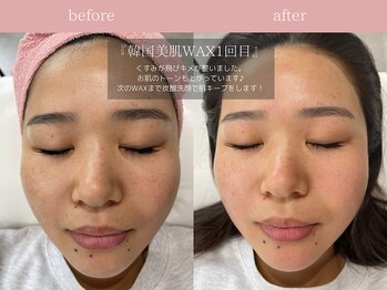 ジョリー(JOLi)/顔脱毛/韓国美肌ワックス