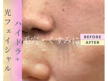 Cスキンケアクリニック 麻布店/ハイドラ+光フェイシャル