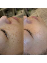 コア バイ サラ 九大学研都市店(koa by SARA)/ララピール☆