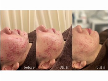 アイル 高槻店(iru)/ハーブピーリングで肌質改善