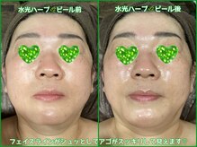 リンク(rinc。)の雰囲気（【水光ピール】水に濡れた様な艶やかな肌と引き締め効果が人気！）