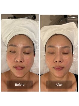 マインエム(mine.m)/ヘッドスパ感覚の頭蓋骨小顔矯正